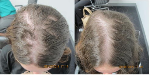 Case Study: Female Lasercap Treatment, Restore Your Hair Naturally