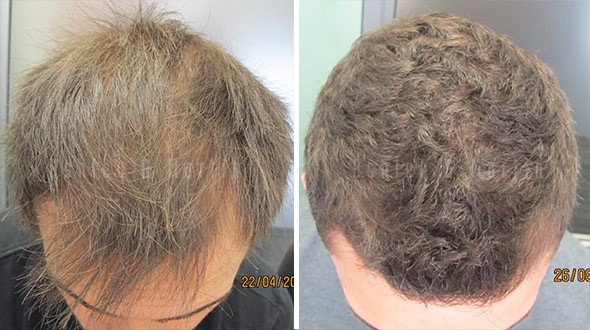 Ashley and Martin Medical Treatment Achieves Hair Regrowth Results in Four