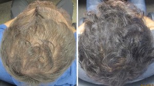 pattern hair loss