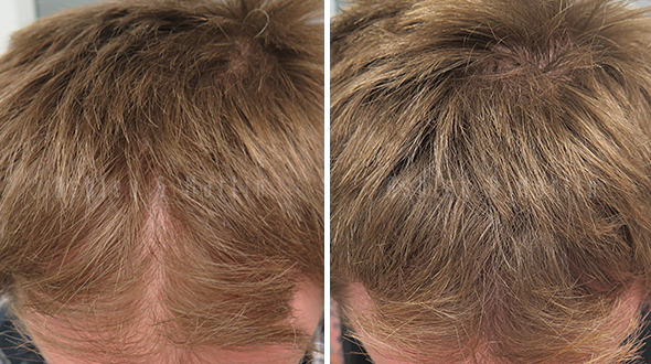 Case Study: Understanding Friend Recommends Ashley and Martin for Hair Loss