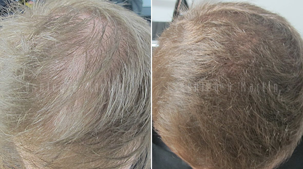 Drastic Hair Loss Reversed Four Months into Ashley and Martin Treatment